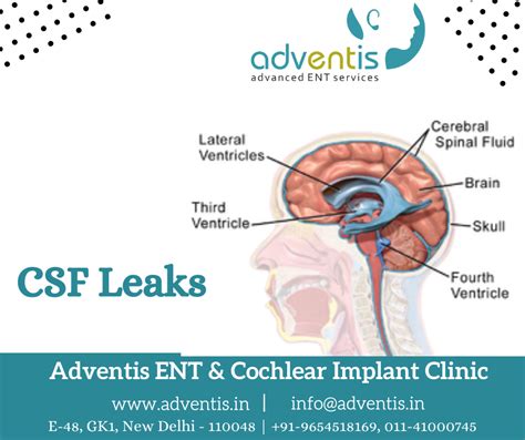 csf leak from nose test|Cerebrospinal Fluid Leak Repair 